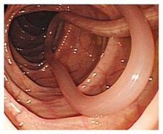 parazīti cilvēka organismā