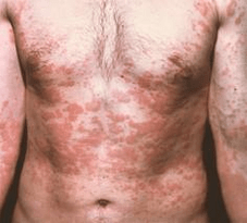 problemātiska āda ir parazītu klātbūtnes simptoms